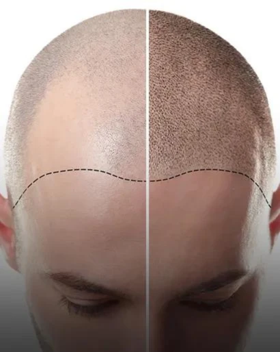 Scalp micropigmentation before and after — restored hairline