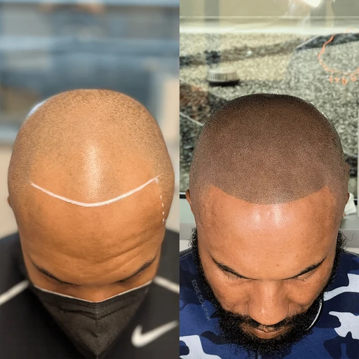 Scalp micropigmentation before and after results